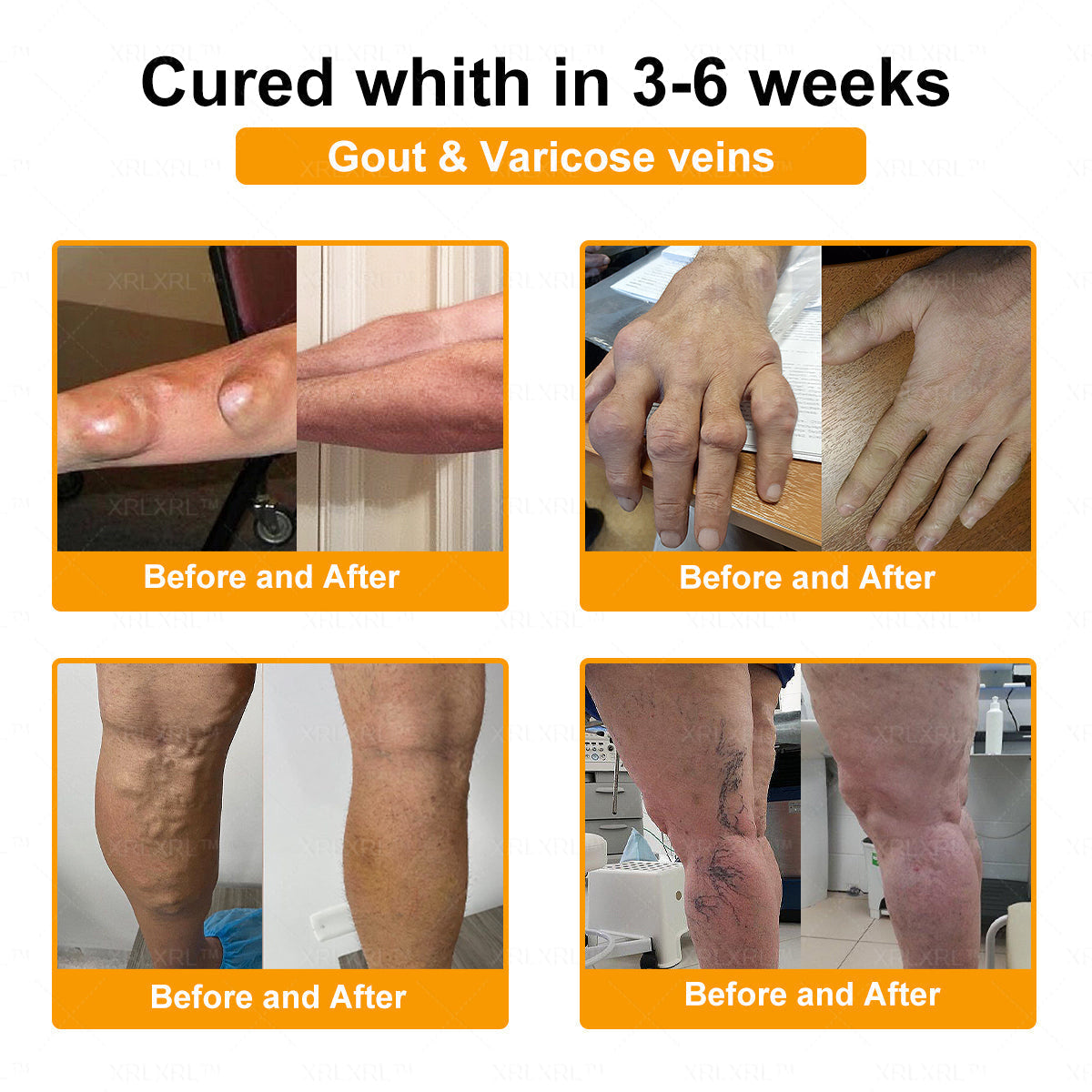 Purelora®💞💞 Bee Venom Pain-Relief Bone Healing Cream  (Specially for older adults)