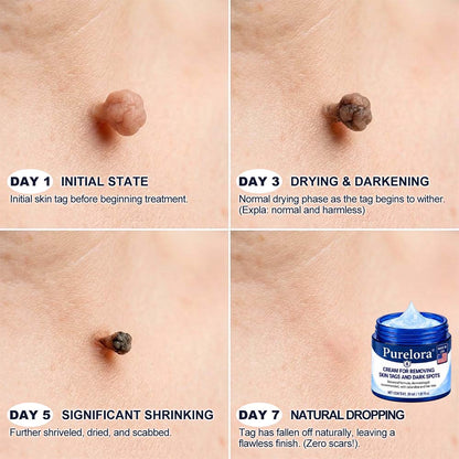 👩‍⚕️Purelora®7-𝐃𝐚𝐲 𝐒𝐤𝐢𝐧 𝐓𝐚𝐠 & 𝐒𝐩𝐨𝐭 𝐄𝐫𝐚𝐬𝐞𝐫 𝐂𝐫𝐞𝐚𝐦(Zero Pain, Zero 𝐒𝐜𝐚𝐫𝐬 Formula)💪
