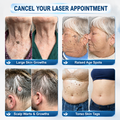 👩‍⚕️Purelora®7-𝐃𝐚𝐲 𝐒𝐤𝐢𝐧 𝐓𝐚𝐠 & 𝐒𝐩𝐨𝐭 𝐄𝐫𝐚𝐬𝐞𝐫 𝐂𝐫𝐞𝐚𝐦(Zero Pain, Zero 𝐒𝐜𝐚𝐫𝐬 Formula)💪