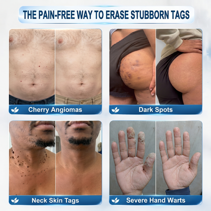 👩‍⚕️Purelora®7-𝐃𝐚𝐲 𝐒𝐤𝐢𝐧 𝐓𝐚𝐠 & 𝐒𝐩𝐨𝐭 𝐄𝐫𝐚𝐬𝐞𝐫 𝐂𝐫𝐞𝐚𝐦(Zero Pain, Zero 𝐒𝐜𝐚𝐫𝐬 Formula)💪