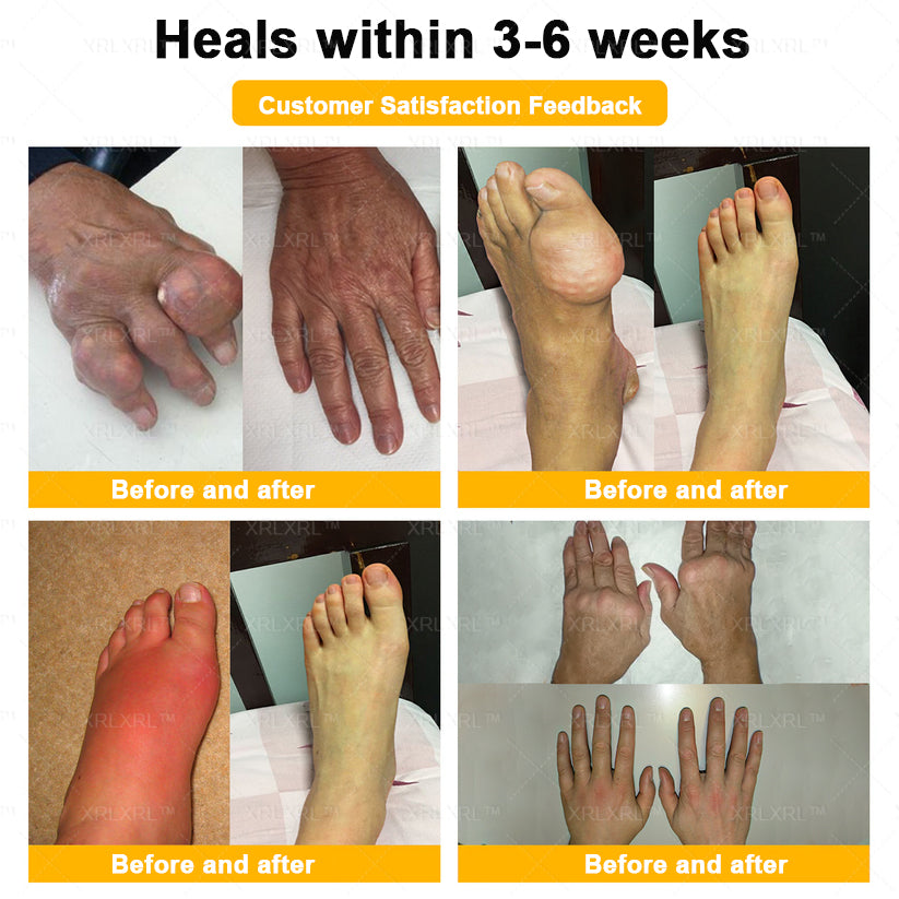 Purelora®💞💞 Bee Venom Pain-Relief Bone Healing Cream  (Specially for older adults)